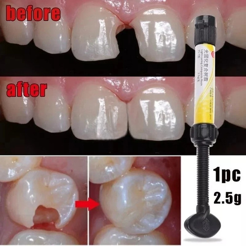 Dental resin cavity filling - dental,