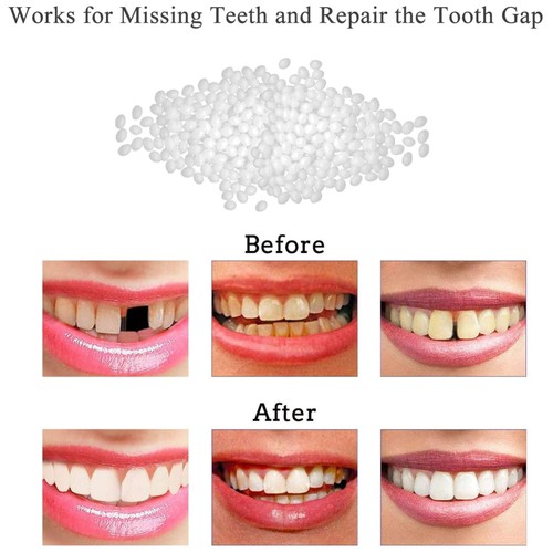 Tooth repair kit filling fix - repair,